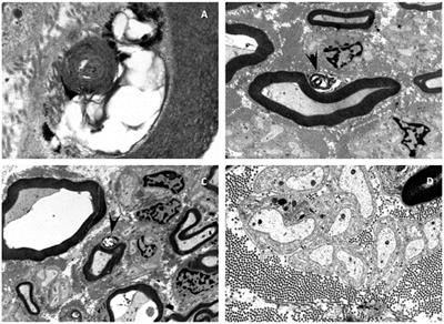 Severe Form of ßIV-Spectrin Deficiency With Mitochondrial Dysfunction and Cardiomyopathy—A Case Report